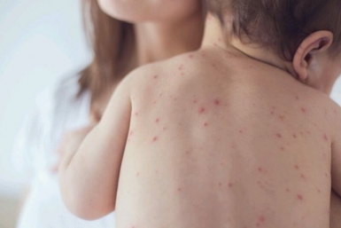 Корь Мэрия Якутска